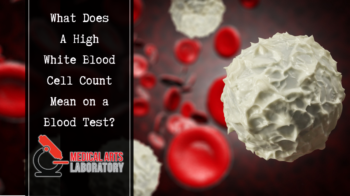 What Does a High White Blood Cell Count Mean on a Blood Test?