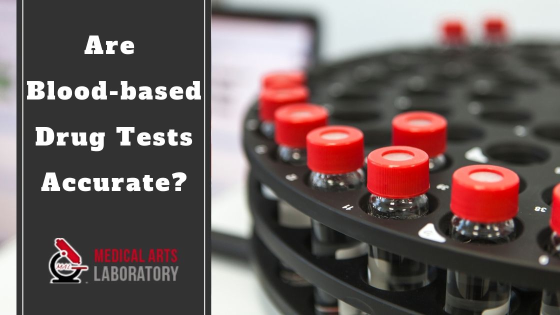 Are Bloodbased Drug Tests Accurate? Medical Arts Laboratory